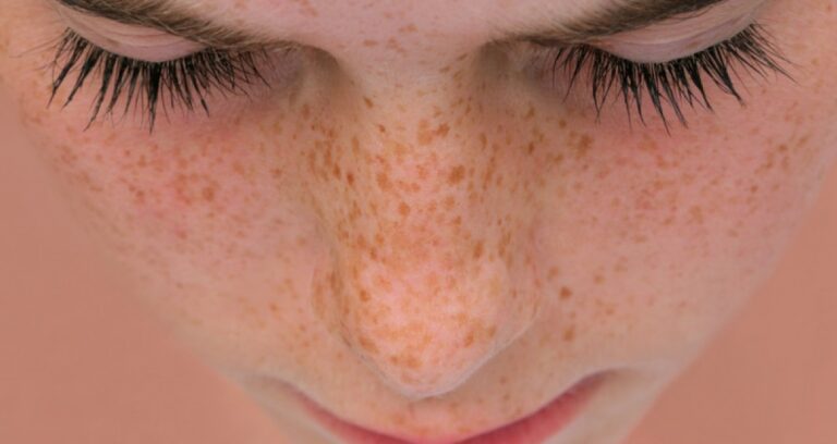 yaz-sonrasi-cilt-lekesi-artanlar-dikkat-Nz6hkwq4.jpg
